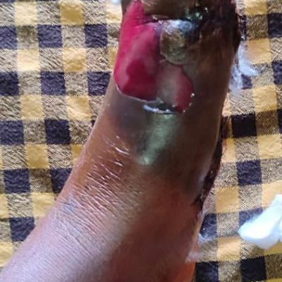 Gangrene1
