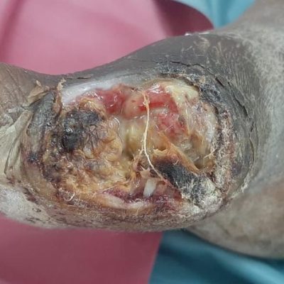 Gangrene2