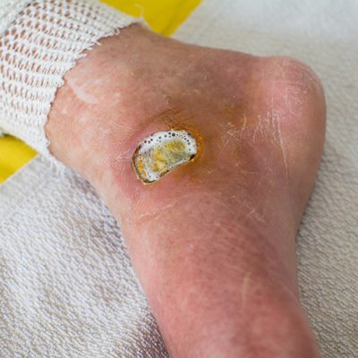 best Diabetic Foot surgeon in pune