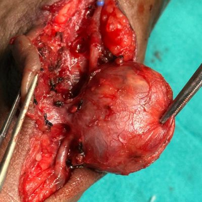 Aneurysm at AV Fistula site