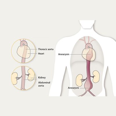 aorotic aneurysm