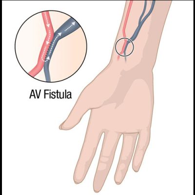 Dialysis-fistula-low-risk