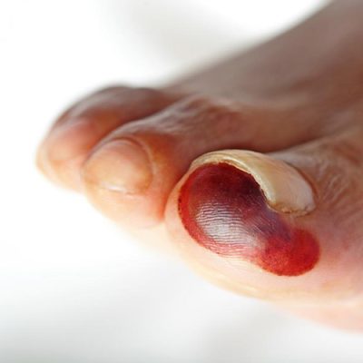 Gangrene